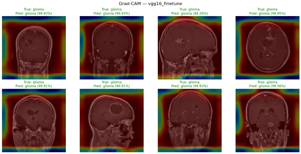 Grad-CAM visualisations from the MRI classification project